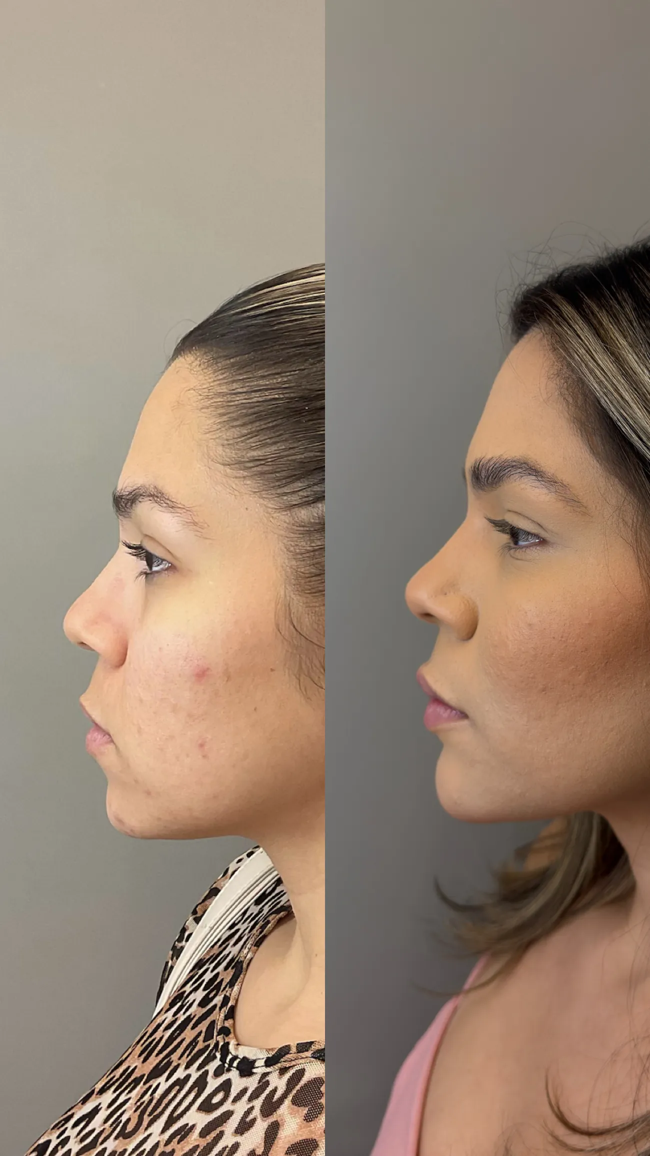 Antes e depois de harmonização facial na NC Clinic, Fortaleza
