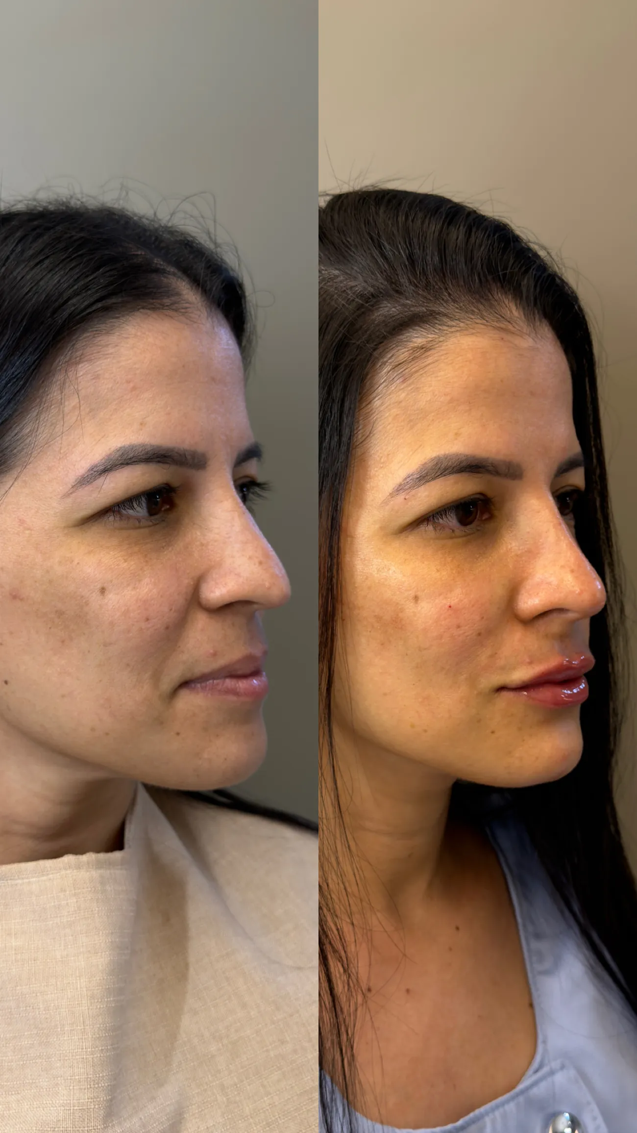 Antes e depois de contorno facial na NC Clinic, Fortaleza