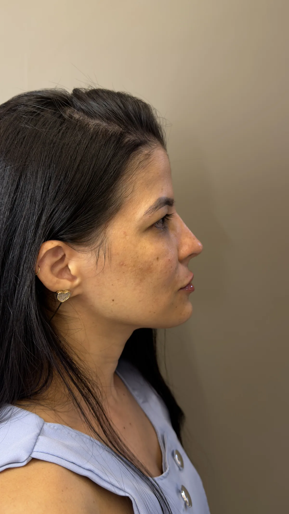 Bioestimuladores de colágeno