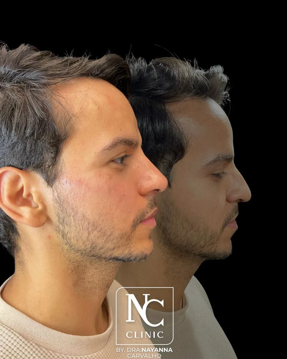 Resultado de harmonização facial masculina na NC Clinic