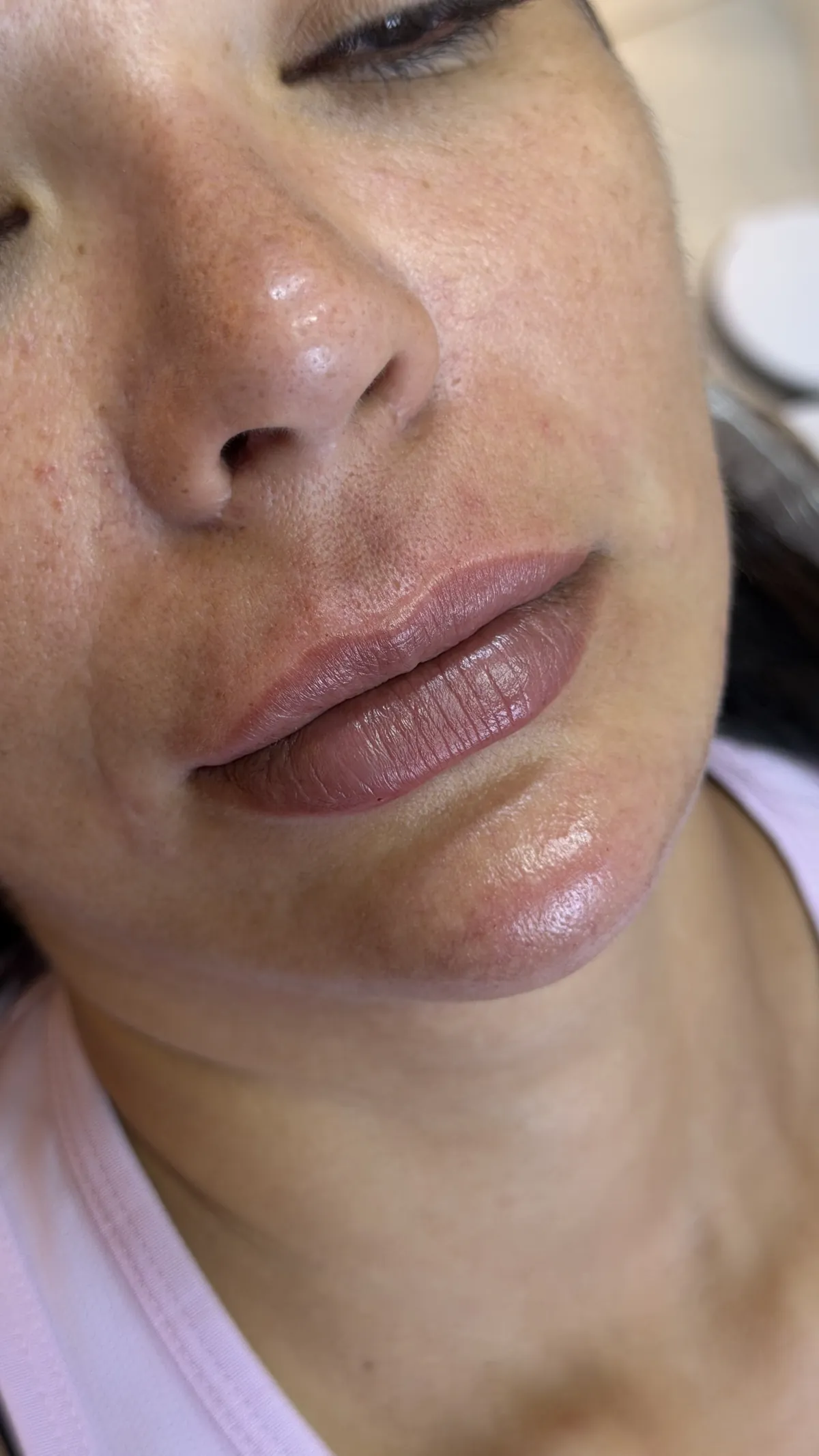 Preenchimento labial
