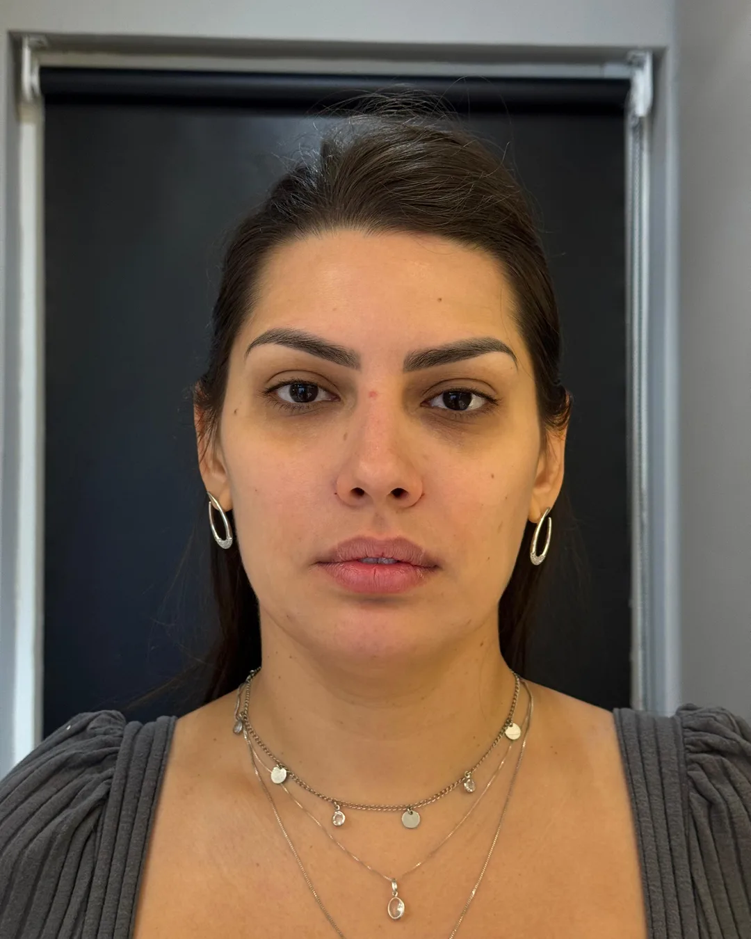 Preenchimentos faciais