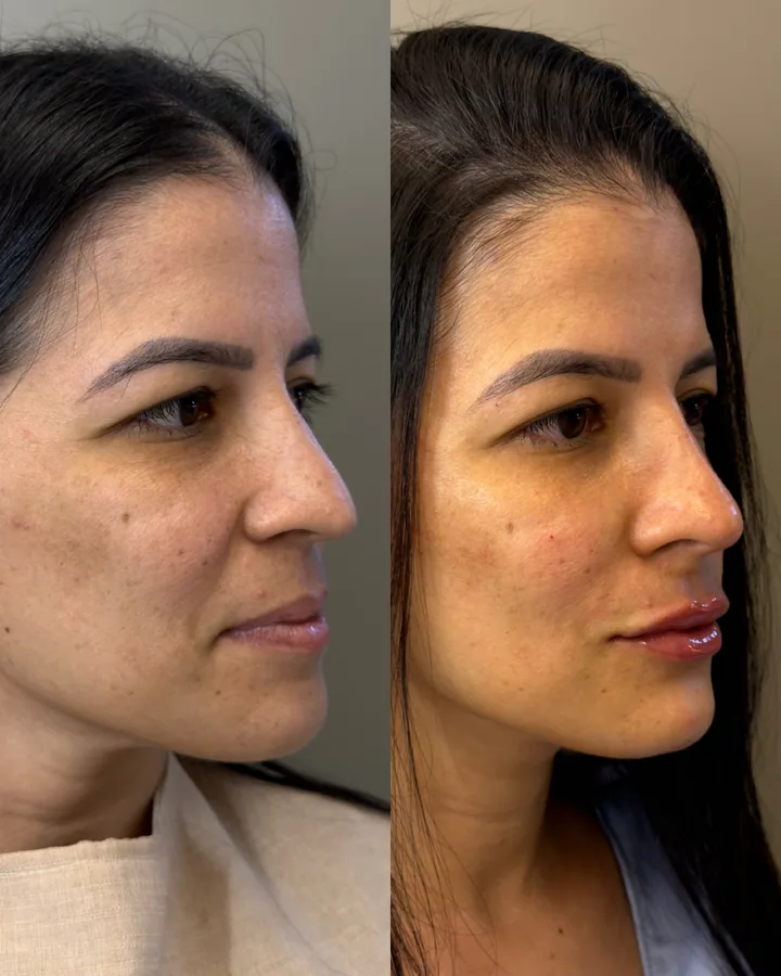 Antes e depois de paciente com o método Single Contour na NC Clinic, Fortaleza